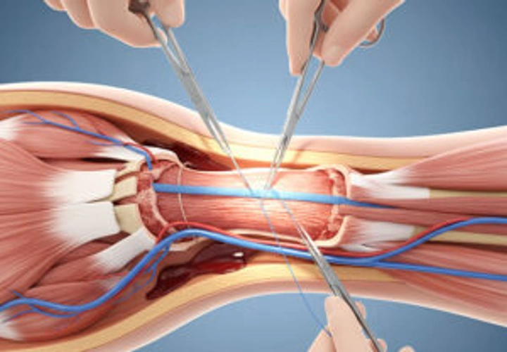 Hand & Limb Reconstruction